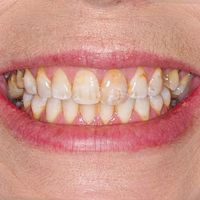 Dental Bonding - Smile 26 before